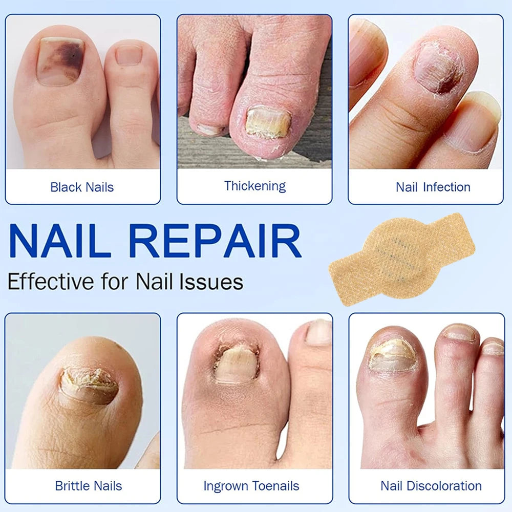 NAIL REPAIR PATCH